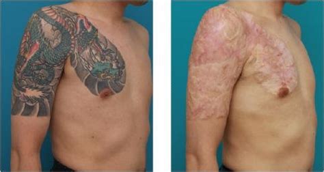 tattoo removal methods procedure benefits risks healthmd