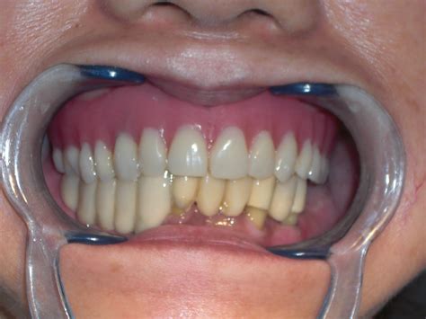 dental implantology case  full upper full denture stabilization