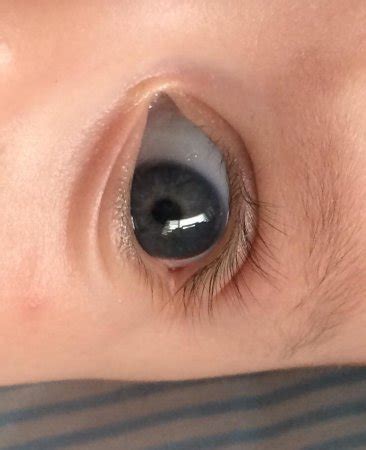 clear bubble  white part  eyeball photo included babycenter