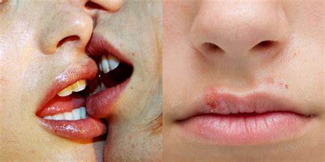 5 diseases and infections you can get from kissing self