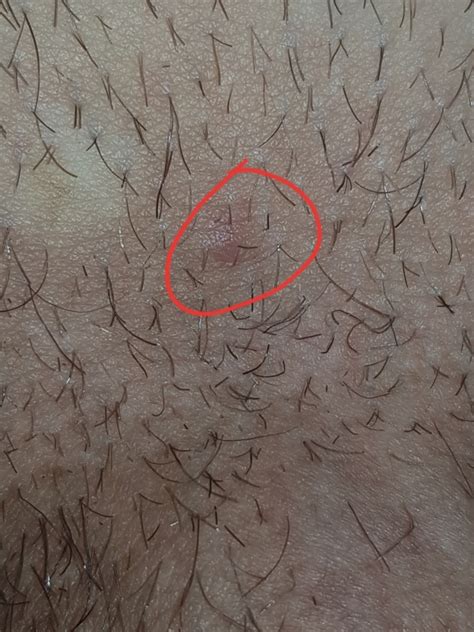 is this dark bump on the base of my penis a genital wart sexual