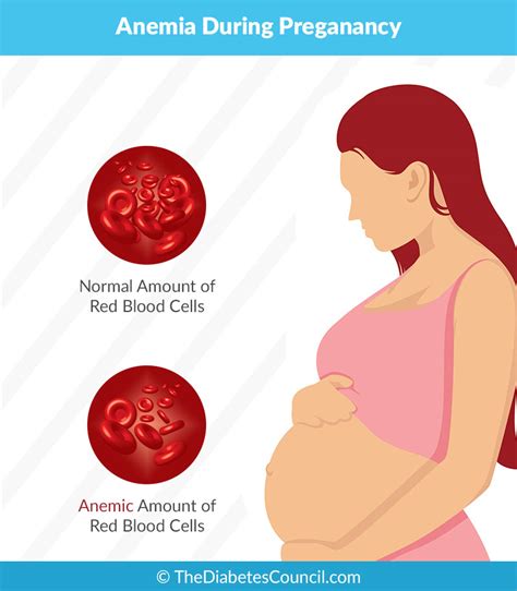 iron deficiency anemia in pregnant women sara fuck