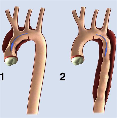 acute aortic dissections  entry tear   arch  report