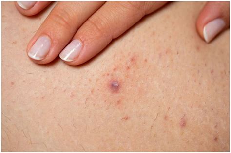 Folliculitis Vs Herpes Symptoms Causes Pictures Differences