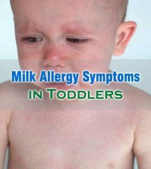 common milk allergy symptoms  toddlers    milk allergy symptoms milk allergy