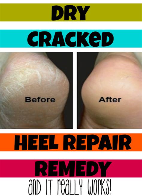 Cracked Heel Remedy Make Your Feet And Heels Super Soft Beauty