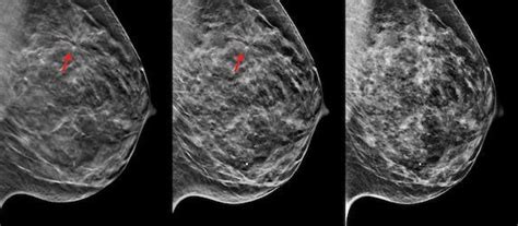 3d mammography named ‘hottest clinical procedure for the fourth