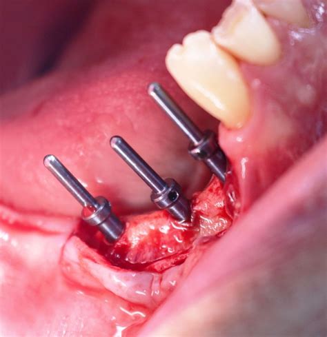 ¿ Implante Dental En El 2020 Pros Y Contras Odontologists