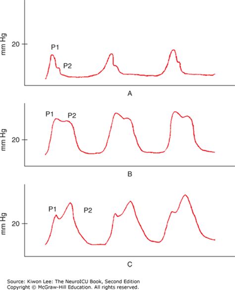 management  increased intracranial pressure neupsy key