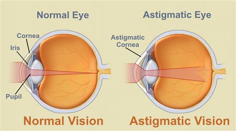 astigmatism  health guide