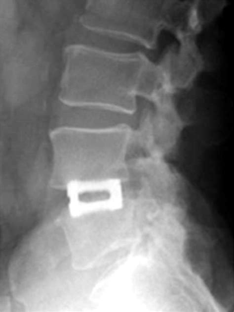 treatment of symptomatic lumbar disc degeneration with the varilift l