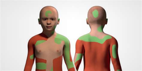 gene therapy skin grafts save boy  rare disease nbc news