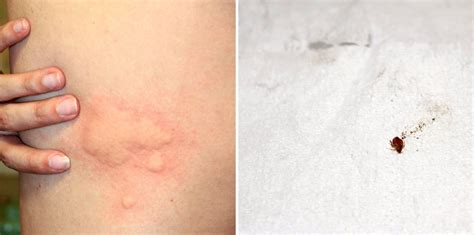 identify  stop bed bug bites debedbug