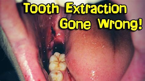 wisdom teeth removal extraction youtube