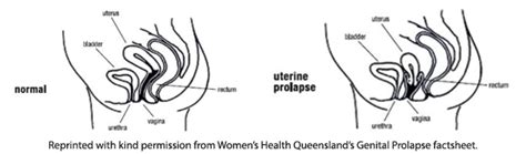 avoiding prolapse when you are working out continence foundation of