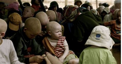 murder  patient  albinism shocks community esther ireland