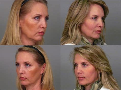 botox before after photo gallery atlanta roswell ga