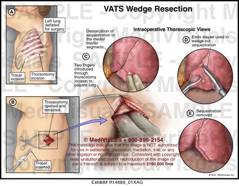 vats wedge resection medivisuals medical illustration
