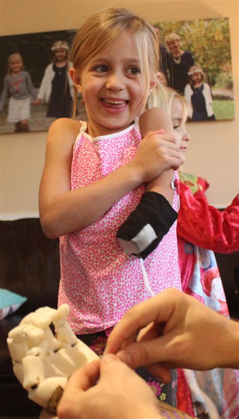 Holiday Miracle 3d Printed Myoelectric Arm Allows Girl