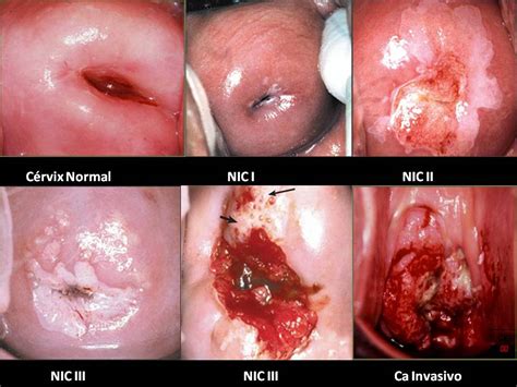 Cervical Cancer Stepwards