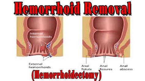 Hemorrhoidectomy Hemorrhoidectomy Surgery Recovery