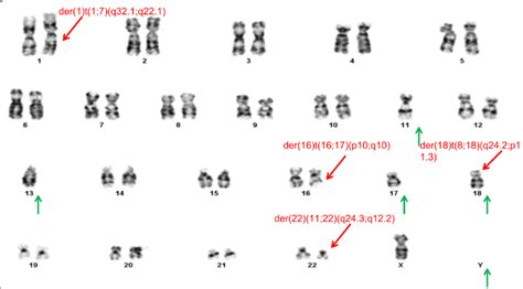 a representative abnormal karyotype showing chromosomal structural and