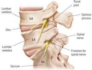 sciatica  lumbar facet joint sprain sydney chiropractor andrew richards explains