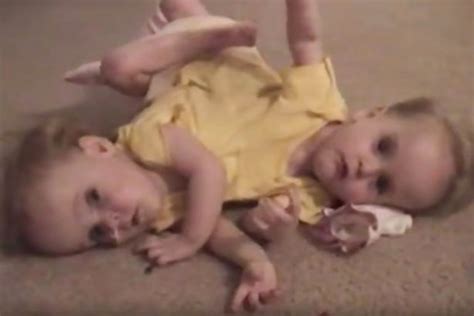 conjoined twins cut in half at 4 now have one leg each and feel like