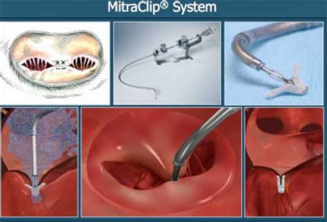 Tiny New Implant ‘mitraclip’ May Usher Revolution In The Treatment Of