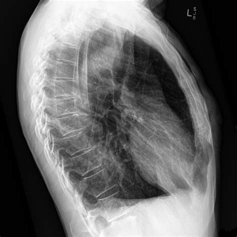 roentgen thorax seitlich copd melanom metastase doccheck