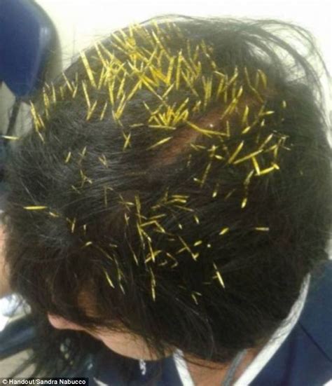 Woman Left With 272 Needles In Head After Porcupine Falls Onto Her From