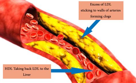 difference  ldl bad cholesterol  hdl good cholesterol upaae