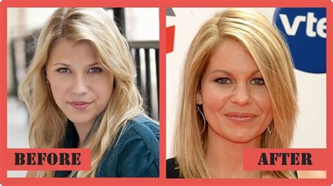Candace Cameron Plastic Surgery The Real Story Candace