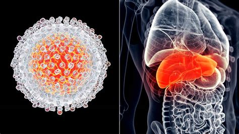 liver cancer understanding your risk factors could save your life