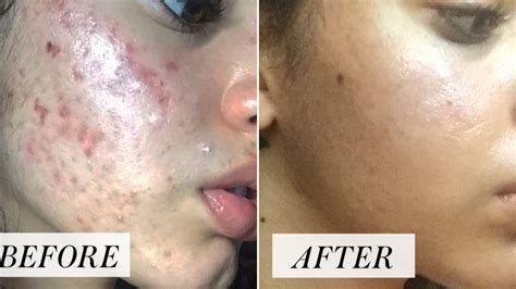 this all natural acne skin care routine is going viral on instagram