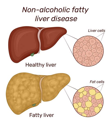 Non Alcoholic Fatty Liver Disease – Know The Symptoms
