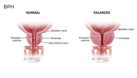 A Comprehensive Guide To Urology Common Urologic Disease