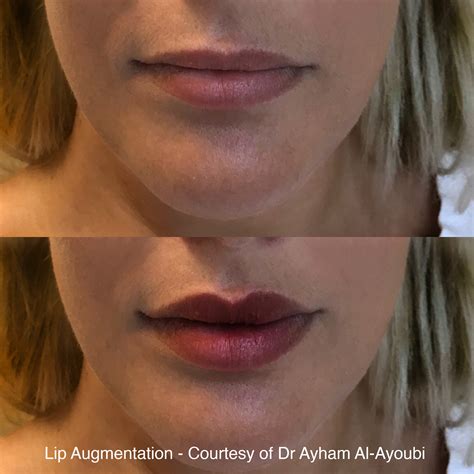 lip enhancement lip fillers harley street london best advice and reviews