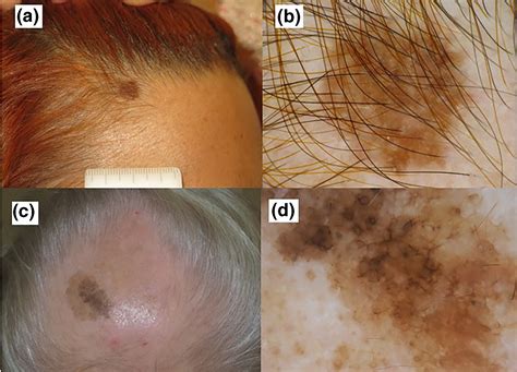melanoma  scalp pictures early stage  scalp melanoma images