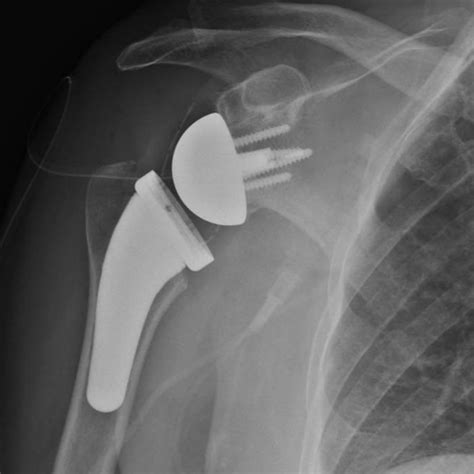 reverse shoulder replacement patient story orthopedic