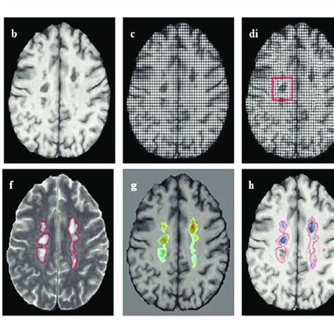 Pdf Slowly Expanding Evolving Lesions As A Magnetic Resonance Imaging
