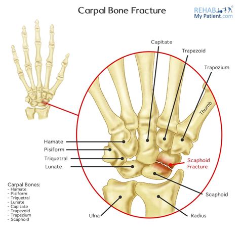 carpal bone fracture rehab  patient