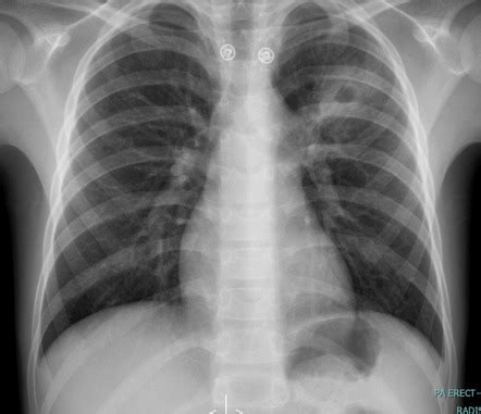 cavitary lung lesion radiology case radiopaediaorg