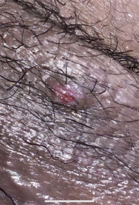 Bump Near Vagina Help Please [warning Graphic Image ] Sexual