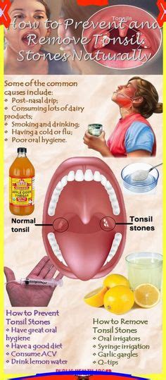 pin  tonsil stones remedies