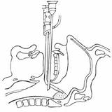 Endoscopic Adenoidectomy Adenoid Debrider Chetana Naik sketch template