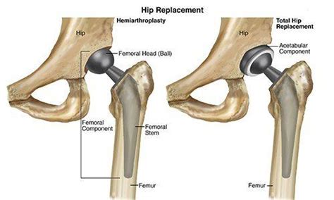 Physical Therapist S Guide To Total Hip Replacement