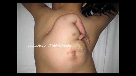 surgery for schoolgirl 11 with an arm growing on her