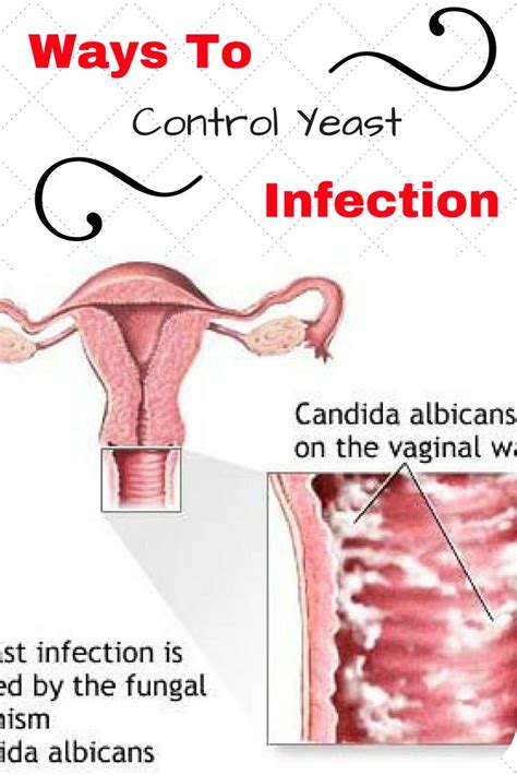 Ways To Control Yeast Infection By Yeast