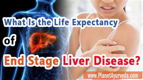 What Is The Life Expectancy Of End Stage Liver Disease 247healthblog